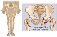 Imagen descriptiva de los lugares posibles para una fractura de cadera.