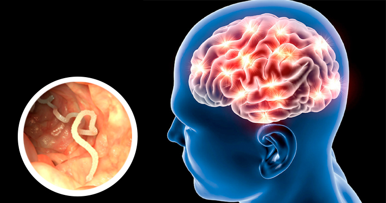 La enfermedad que genera la Taenia solium en el cuerpo humano figura entre las causas más severas de morbilidad y mortalidad de nuestro país, una de ellas, la neurocisticercosis (cuando los cisticercos se localizan en el cerebro).