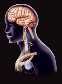 La terapia de estimulación del nervio vago se recomienda cuando el paciente tiene una epilepsia fármaco-resistente y no es candidato al tratamiento quirúrgico o no quiere someterse a una cirugía cerebral.
