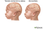 La microcefalia se caracteriza por el tamaño menor al normal de la cabeza del recién nacido presenta un tamaño,  no es un problema nuevo, y no es el Zika el que lo ha producido por primera vez.