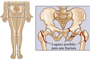 Imagen descriptiva de los lugares posibles para una fractura de cadera.
