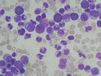 El 60% de los pacientes con alguna enfermedad de la sangre presentan alteraciones cromosómicas en las células troncales mesenquimales. En la imagen, micrografía de la Leucemia Mieloide Crónica.