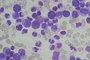 El 60% de los pacientes con alguna enfermedad de la sangre presentan alteraciones cromosómicas en las células troncales mesenquimales. En la imagen, micrografía de la Leucemia Mieloide Crónica.
