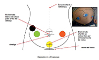 Forma de colocación de los electrodos en el abdomen materno y dispositivo MONICA para gestaciones mayores a 33 semanas, el cual permite calcular la actividad eléctrica cardíaca de la madre, del producto y la uterina.