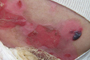 Heridas y ampollas originadas por epidermólisis bullosa.