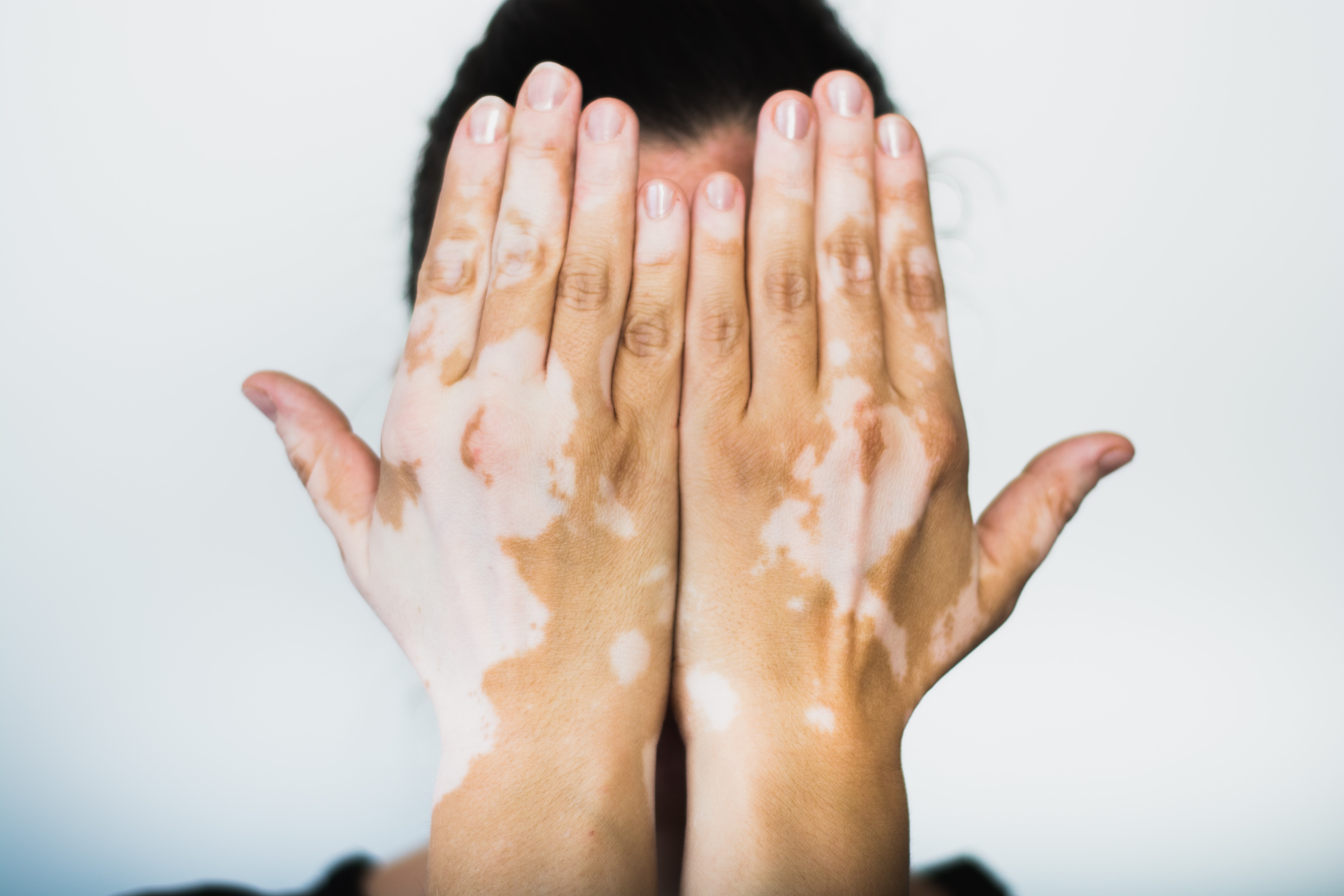El vitiligo es una patología no contagiosa que se presenta en hombres y mujeres de todo el mundo.