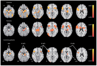 Regiones activadas para la tarea de identificación de emociones. Controles (fila superior), pacientes esquizofrénicos (fila del centro), y el contraste control-pacientes (fila inferior). Tomada de: Raquel E. Gur. 2010. Functional magnetic resonance imaging in schizophrenia. Dialogues Clin. Neurosci. 12(3): 333–343.