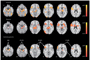 Regiones activadas para la tarea de identificación de emociones. Controles (fila superior), pacientes esquizofrénicos (fila del centro), y el contraste control-pacientes (fila inferior). Tomada de: Raquel E. Gur. 2010. Functional magnetic resonance imaging in schizophrenia. Dialogues Clin. Neurosci. 12(3): 333–343.